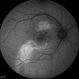 Multifocal CSCR 1 Multifocal CSCR 1